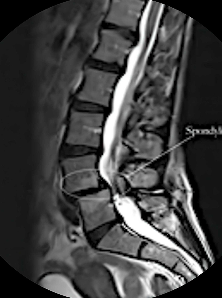 L4/L5 spondylolisthesis illustration