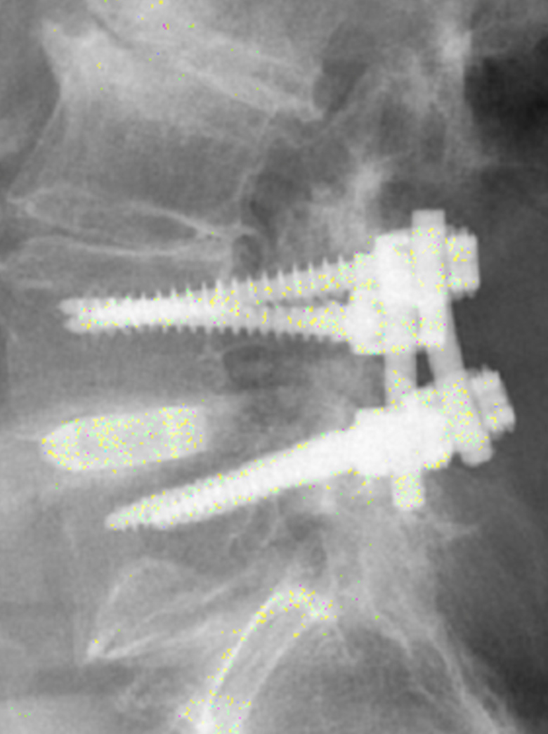 Pedicle screw placement illustration