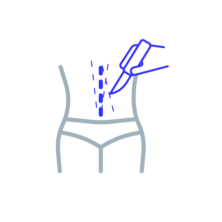 Minimally invasive surgical procedure illustration depicting abdominal surgery or liposuction technique.