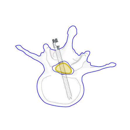 Minimally invasive spinal surgery illustration showing advanced screw and cage implantation for spinal stabilization and recovery.