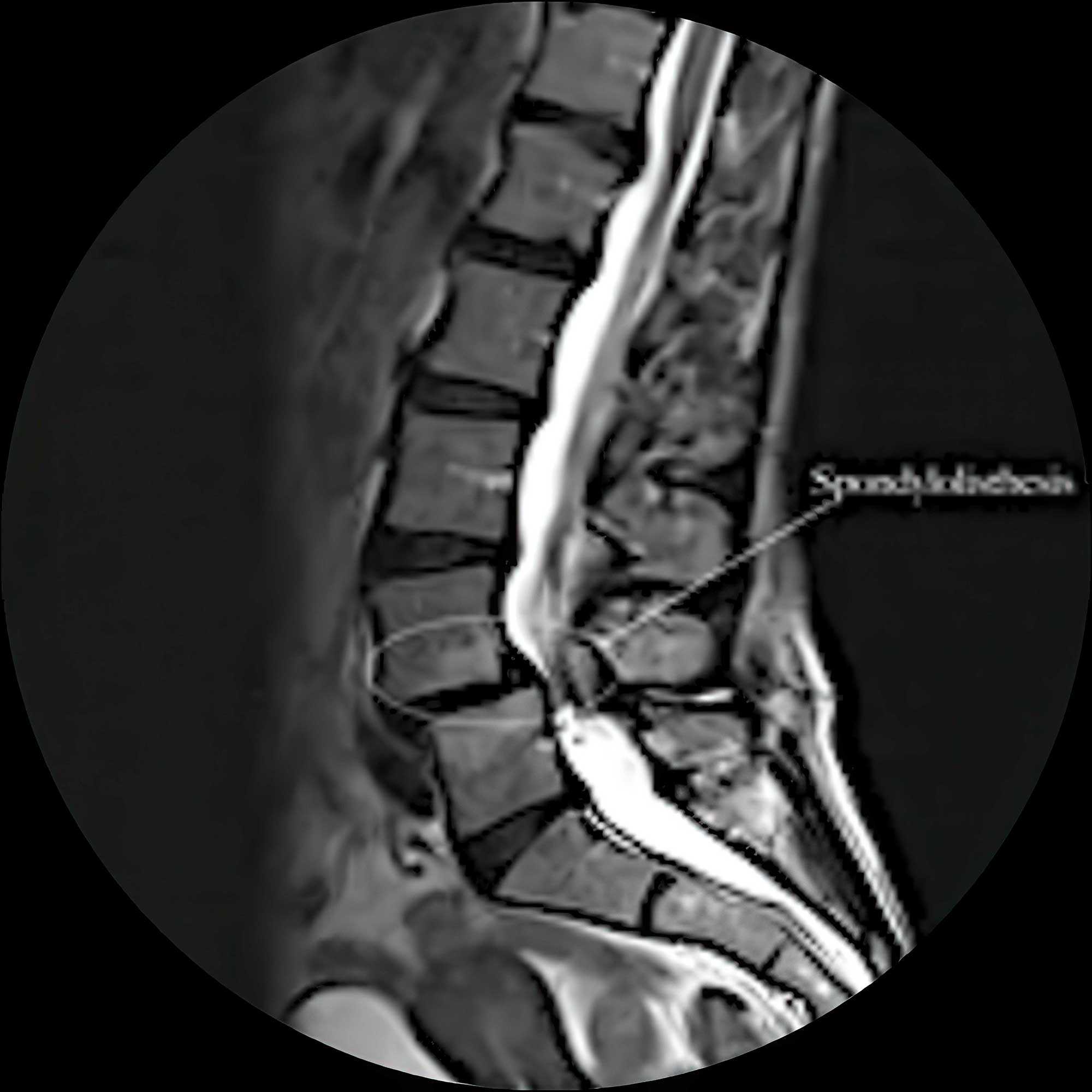 Spinal MRI scan showing vertebrae, spinal cord, and disc spaces, highlighting advanced imaging for accurate diagnosis of spinal conditions and surgical planning.