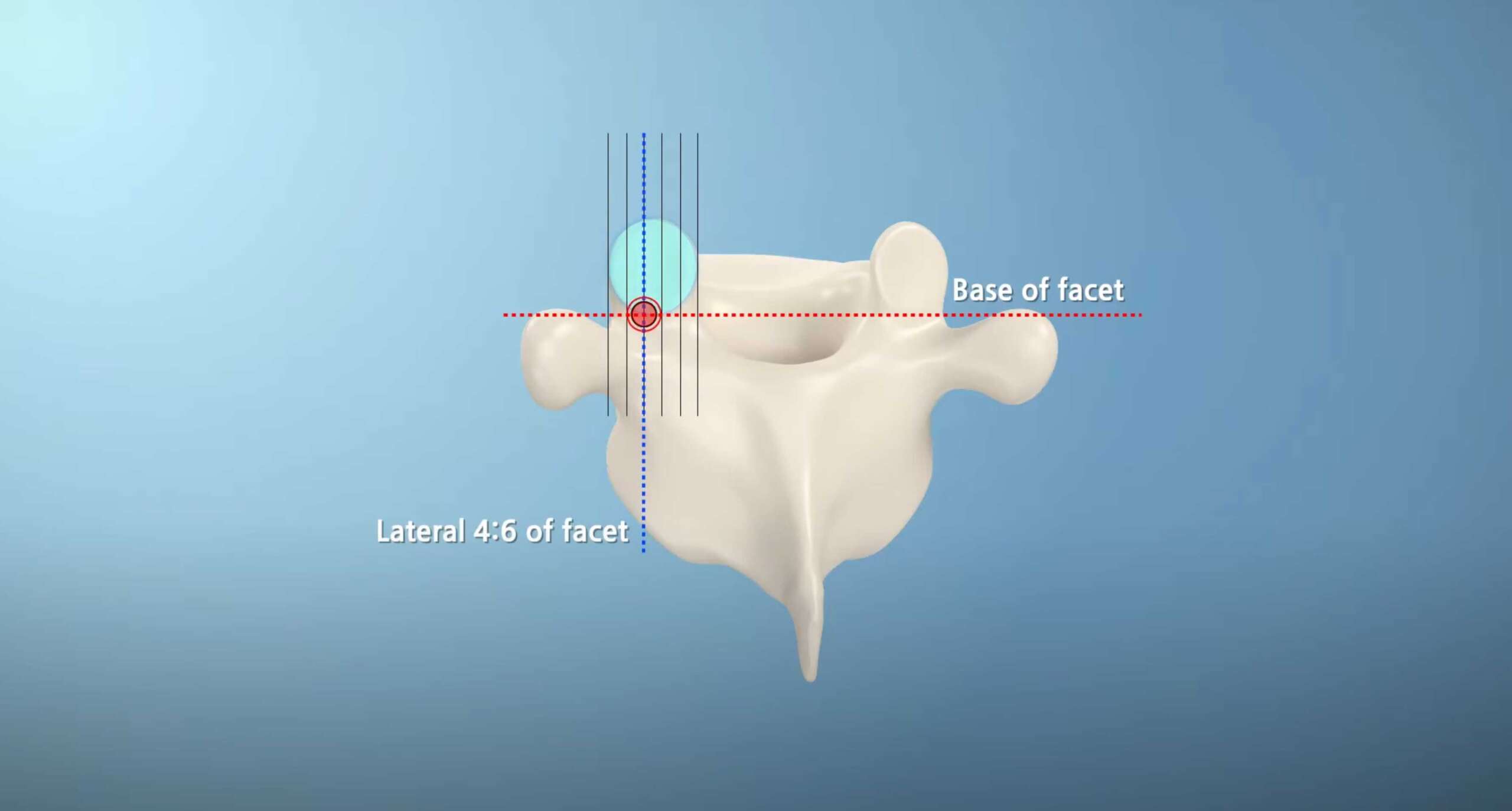 Minimally invasive spine surgery procedure illustration showing precise needle placement and anatomical target points for safe surgical intervention.