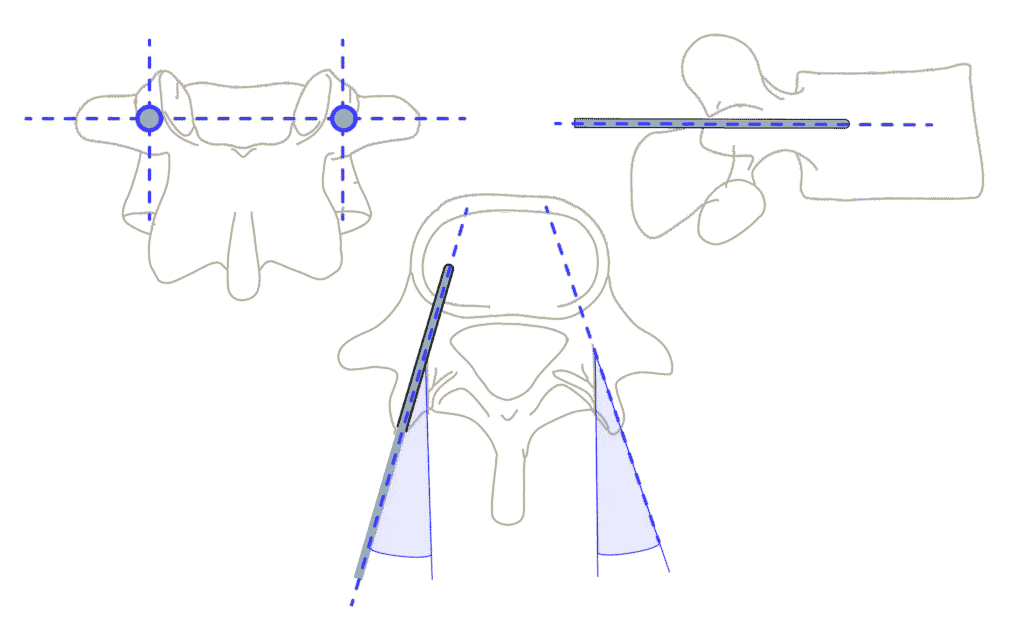 Minimally invasive spine surgery approach illustration showing patient positioned for the procedure with image annotations highlighting key surgical steps.
